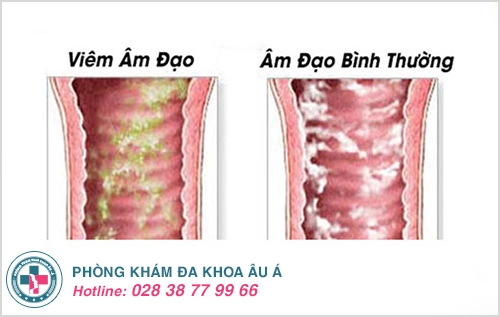 Hiện tượng hôi âm đạo ở nữ giới là dấu hiệu của bệnh gì?