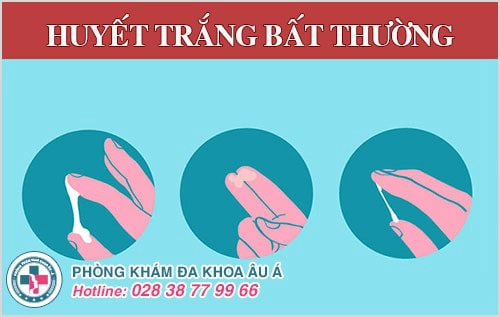 huyết trắng bất thường