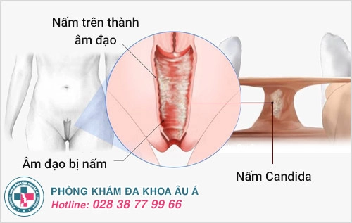 nấm phụ khoa, nấm âm đạo