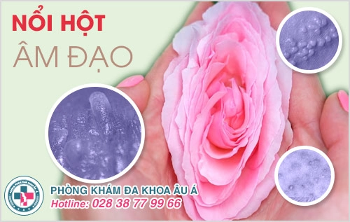 nổi hột âm đạo