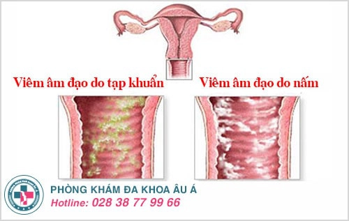 khí hư đặc