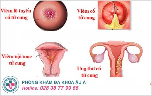 khí hư đặc