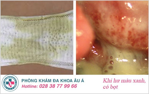 Khí hư bất thường - cảnh báo nhiều bệnh phụ khoa nguy hiểm