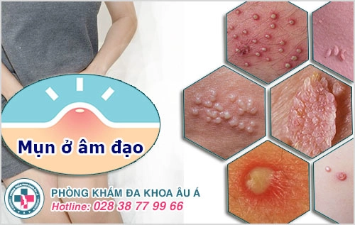 Mụn âm đạo là bệnh gì? Chữa bằng phương pháp nào?