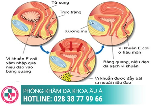 Viêm đường tiết niệu