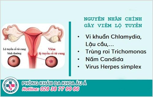 Nguyên nhân viêm lộ tuyến là gì