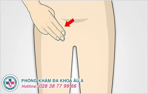 Nổi hạch vùng kín ở nam và nữ là bệnh gì?