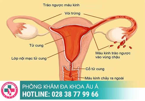 BỆNH PHÌ ĐẠI CỔ TỬ CUNG LÀ GÌ?