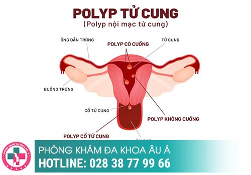 Polyp cổ tử cung chia làm mấy giai đoạn?