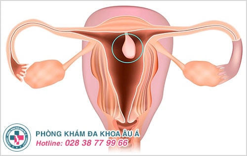 Polyp tử cung là gì? Có nguy hiểm không?v