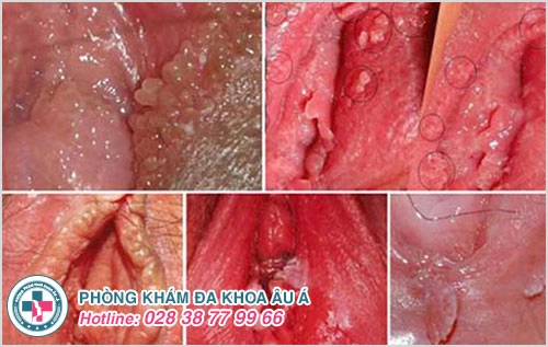 Đau vùng kín là dấu hiệu của bệnh gì?