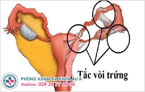 Kinh nguyệt có mùi hôi – Điều gì khiến chị em lo ngại?