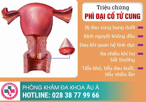 BIỂU HIỆN CỦA BỆNH PHÌ ĐẠI CỔ TỬ CUNG RA SAO?