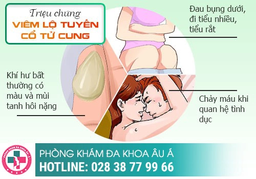 Viêm lộ tuyến cổ tử cung