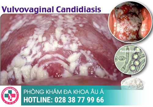 Vùng kín bị ngứa và nổi hạt