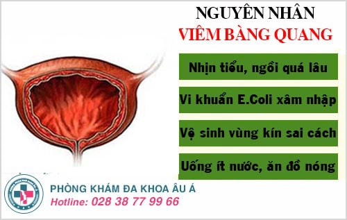 viêm bàng quang