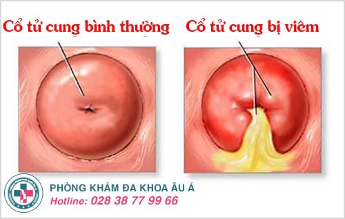 viêm cổ tử cung