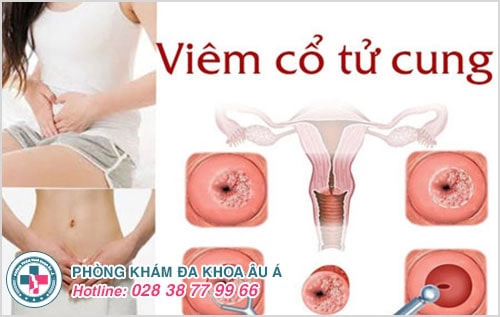 Hỗ trợ điều trị bệnh viêm cổ tử cung hiệu quả bằng phương pháp hiện đại