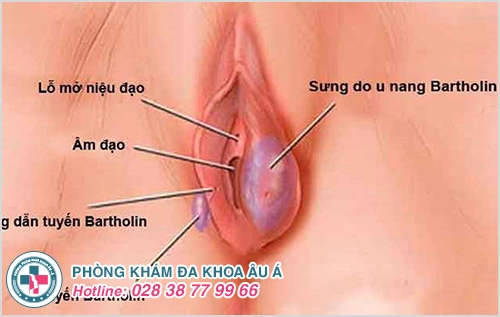 U cục sưng cứng gần âm đạo 