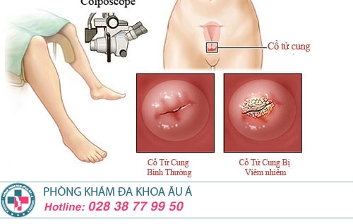 Chi phí đốt viêm lộ tuyến cổ tử cung