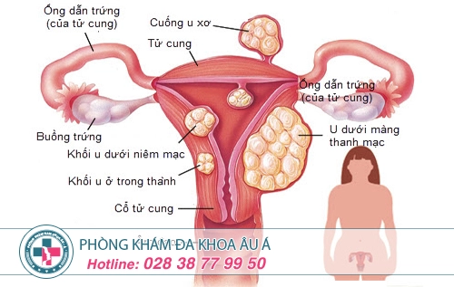 Đau bụng dưới ở nữ