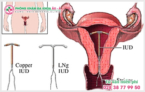 Quy trình đặt vòng tránh thai như thế nào?