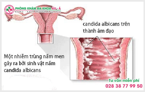 Thuốc chữa viêm âm đạo là loại nào?