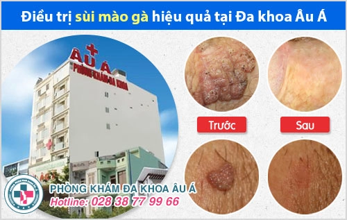địa chỉ chữa sùi mào gà địa chỉ chữa sùi mào gà