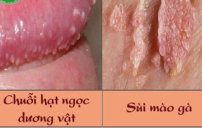 Phân biệt chuỗi hạt ngọc dương vật và sùi mào gà Phân biệt chuỗi hạt ngọc dương vật và sùi mào gà
