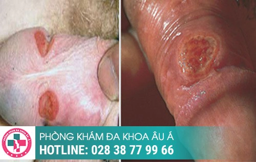 Thời gian ủ bệnh xã hội, bệnh xã hội ủ trong bao lâu, bệnh xã hội bao lâu tái phát Thời gian ủ bệnh xã hội, bệnh xã hội ủ trong bao lâu, bệnh xã hội bao lâu tái phát