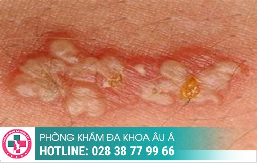 Thời gian ủ bệnh xã hội, bệnh xã hội ủ trong bao lâu, bệnh xã hội bao lâu tái phát Thời gian ủ bệnh xã hội, bệnh xã hội ủ trong bao lâu, bệnh xã hội bao lâu tái phát