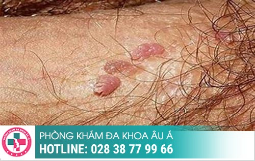 Thời gian ủ bệnh xã hội, bệnh xã hội ủ trong bao lâu, bệnh xã hội bao lâu tái phát Thời gian ủ bệnh xã hội, bệnh xã hội ủ trong bao lâu, bệnh xã hội bao lâu tái phát