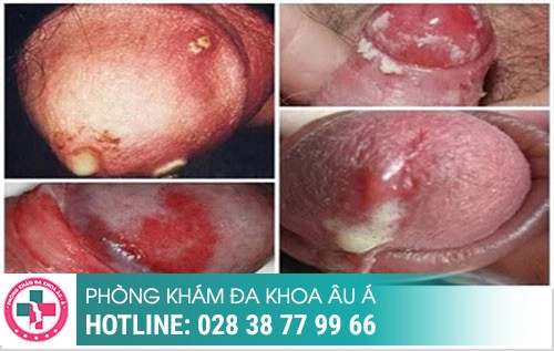 Thời gian ủ bệnh xã hội, bệnh xã hội ủ trong bao lâu, bệnh xã hội bao lâu tái phát Thời gian ủ bệnh xã hội, bệnh xã hội ủ trong bao lâu, bệnh xã hội bao lâu tái phát