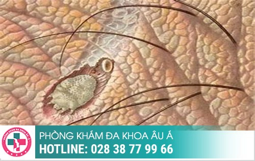 Thời gian ủ bệnh xã hội, bệnh xã hội ủ trong bao lâu, bệnh xã hội bao lâu tái phát Thời gian ủ bệnh xã hội, bệnh xã hội ủ trong bao lâu, bệnh xã hội bao lâu tái phát