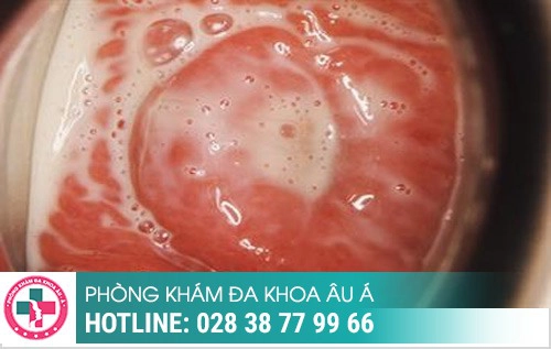 Thời gian ủ bệnh xã hội, bệnh xã hội ủ trong bao lâu, bệnh xã hội bao lâu tái phát Thời gian ủ bệnh xã hội, bệnh xã hội ủ trong bao lâu, bệnh xã hội bao lâu tái phát