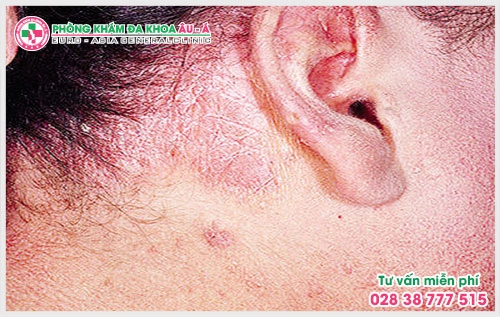 Có rất nhiều người vẫn chưa biết về bệnh vảy nến da đầu như thế nào? Nó rất nguy hiểm. Chính vì thế mà bạn cần phải biết về bệnh vẩy nến trước khi quá muộn.