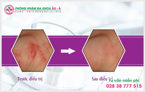 Để hiễu rõ hơn về bệnh ghẻ là gì? Nguyên nhân và cách điều trị hiệu quả thì người bệnh có thể tham khảo ngay bài viết dưới đây.