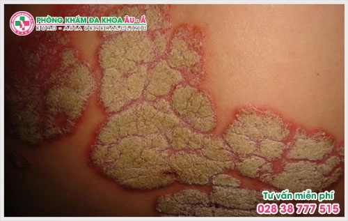 Theo các chuyên gia đầu ngành việc xác định đâu là phòng khám Vảy Nến chất lượng cần dựa vào nhiều tiêu chí khác nhau