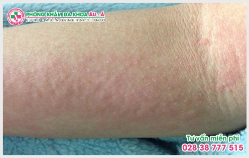 Phòng Khám Da liễu Âu Á đã trở thành địa chỉ khám chữa cũng như tư vấn da liễu đáng tin cậy cho mọi người ở TP.HCM và các khu vực lân cận.