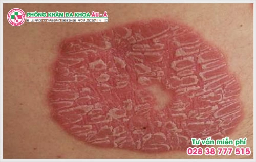 Phòng Khám Da liễu Âu Á đã trở thành địa chỉ khám chữa cũng như tư vấn da liễu đáng tin cậy cho mọi người ở TP.HCM và các khu vực lân cận.