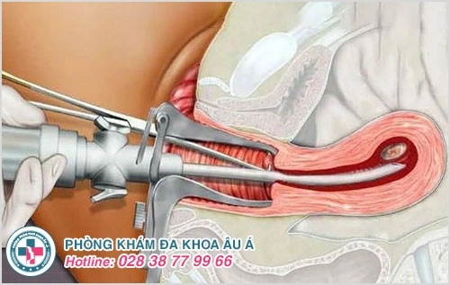 Những thông tin liên quan đến hút thai chân không chị em nên biết Những thông tin liên quan đến hút thai chân không chị em nên biết
